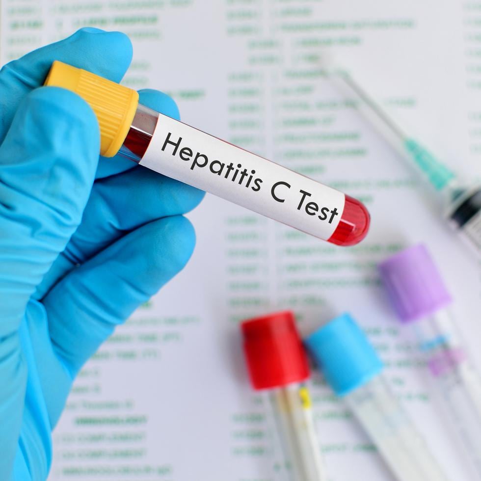 La hepatitis C es una condición inflamatoria del hígado que se transmite cuando una persona entre en contacto con la sangre de una persona infectada.