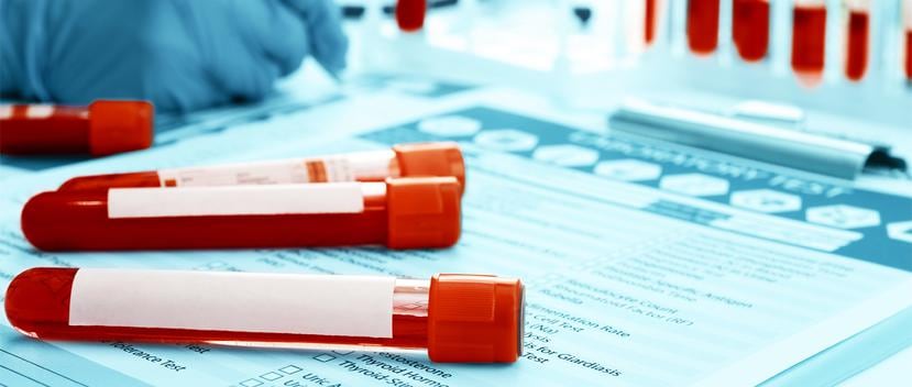 Es importante que las personas se hagan las pruebas para detectar el virus de hepatitis C, especialmente si tiene entre 50 a 75 años y si recibió una trasfusión de sangre antes de 1992. (Shutterstock)