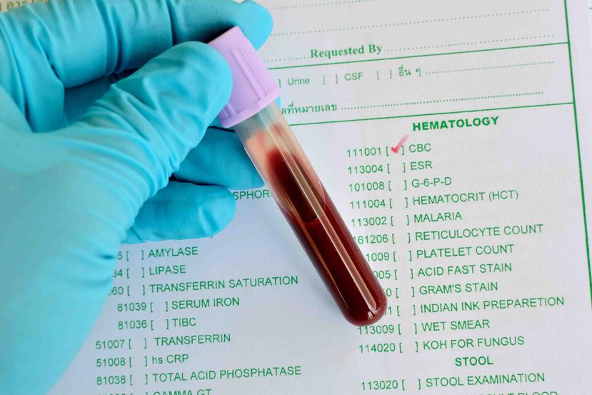 Un simple conteo completo de células sanguíneas, o CBC, por sus siglas en inglés, puede certificar si algo anda mal en nuestra sangre. (Foto: Shutterstock.com)