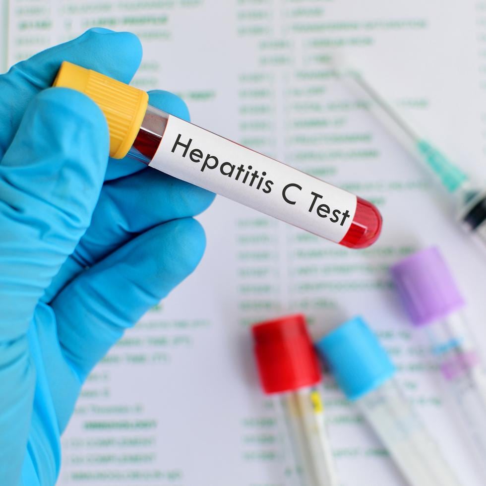 La OMS tiene como principal objetivo la erradicación de la hepatitis de tipo C como problema de salud pública en los próximos siete años.