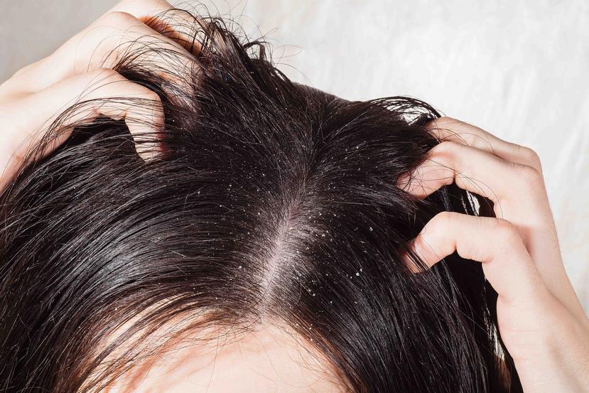 Si te lavas la cabeza consistentemente, el problema debe mejorar.  (Shutterstock)