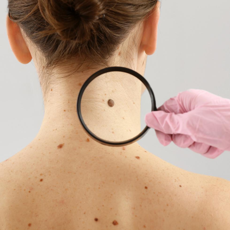 El melanoma no es el cáncer de piel más frecuente, pero si no se detecta y se trata a tiempo es el más peligroso porque se puede propagar a otras partes del organismo. En cambio, si se diagnostica en etapa temprana, la supervivencia es mayor del 90%.