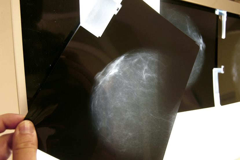 Fotografía de archivo de una prueba radiológica de mama.