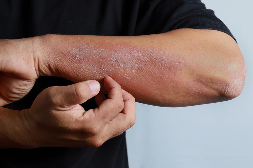 La dermatitis atópica (eccema) es un trastorno que provoca enrojecimiento de la piel y picazón.