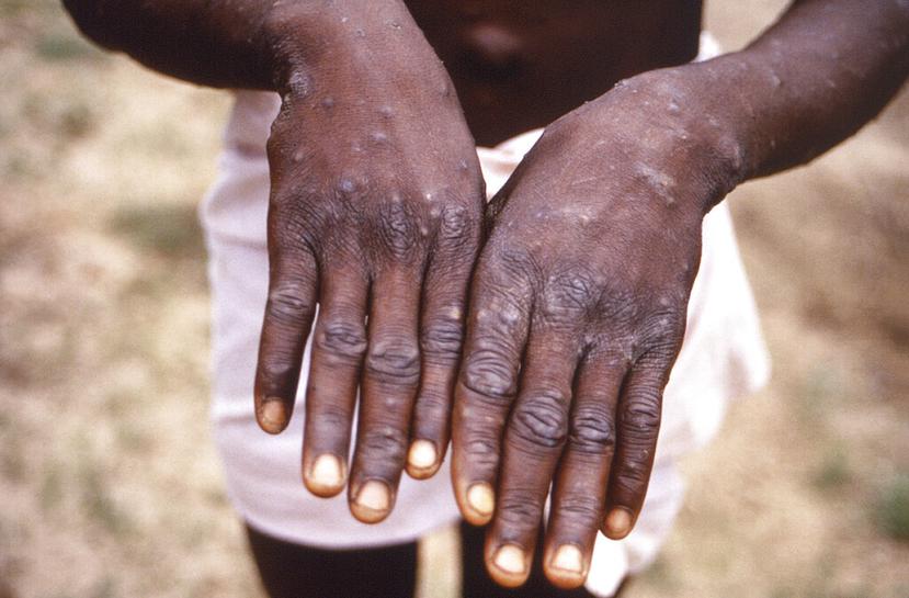 Esta imagen de 1997 proporcionada por los CDC durante una investigación sobre un brote de viruela del mono, que tuvo lugar en la República Democrática del Congo (RDC), anteriormente Zaire, y muestra las superficies dorsales de las manos de un paciente con un caso de viruela del mono, que mostraba la aparición de la erupción característica durante su etapa de recuperación.
