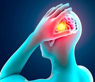 Los síntomas de los aneurismas cerebrales pueden ser diversos e incluyen un dolor de cabeza súbito y severo.