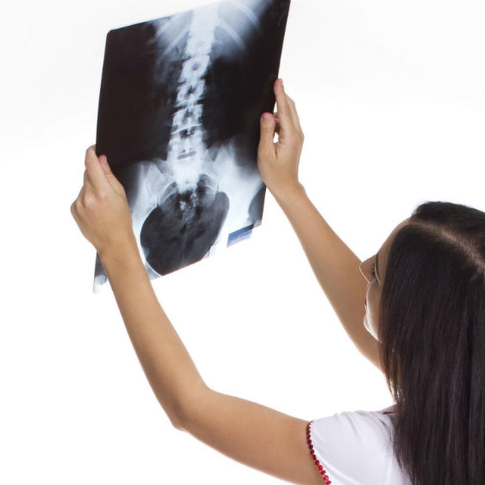 Las fracturas son, sin duda, la principal consecuencia de la osteoporosis. (Foto: Archivo/ GFR Media)