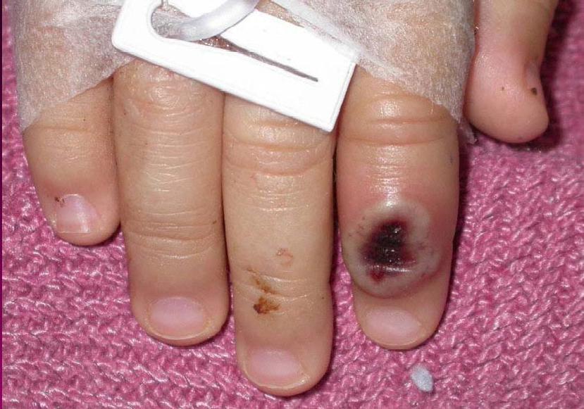 Fotografía de archivo del Centro Estadounidense de Control de las Enfermedades (CDC) en la que se aprecia el dedo de un niño infectado por la llamada viruela de mono.