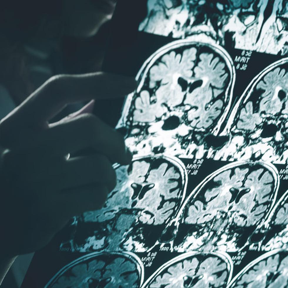 Los biomarcadores más estudiados en la enfermedad de Alzheimer incluyen los estudios de imágenes del cerebro, como resonancia magnética (MRI). (Shutterstock)