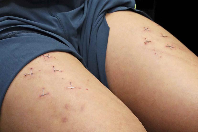 Howard Lam muestra las heridas en sus piernas causadas por una abrochadora durante una conferencia de prensa en Hong Kong. (AP / Apple Daily)