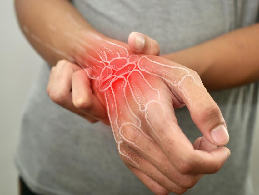 El manejo del dolor es un aspecto fundamental de la artritis.