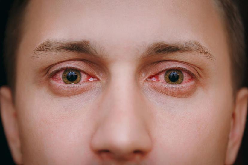 Aunque no está claro que sea fuente de contagio, sí demuestra que la mucosa de los ojos está expuesta a la entrada del virus/ (Shutterstock)