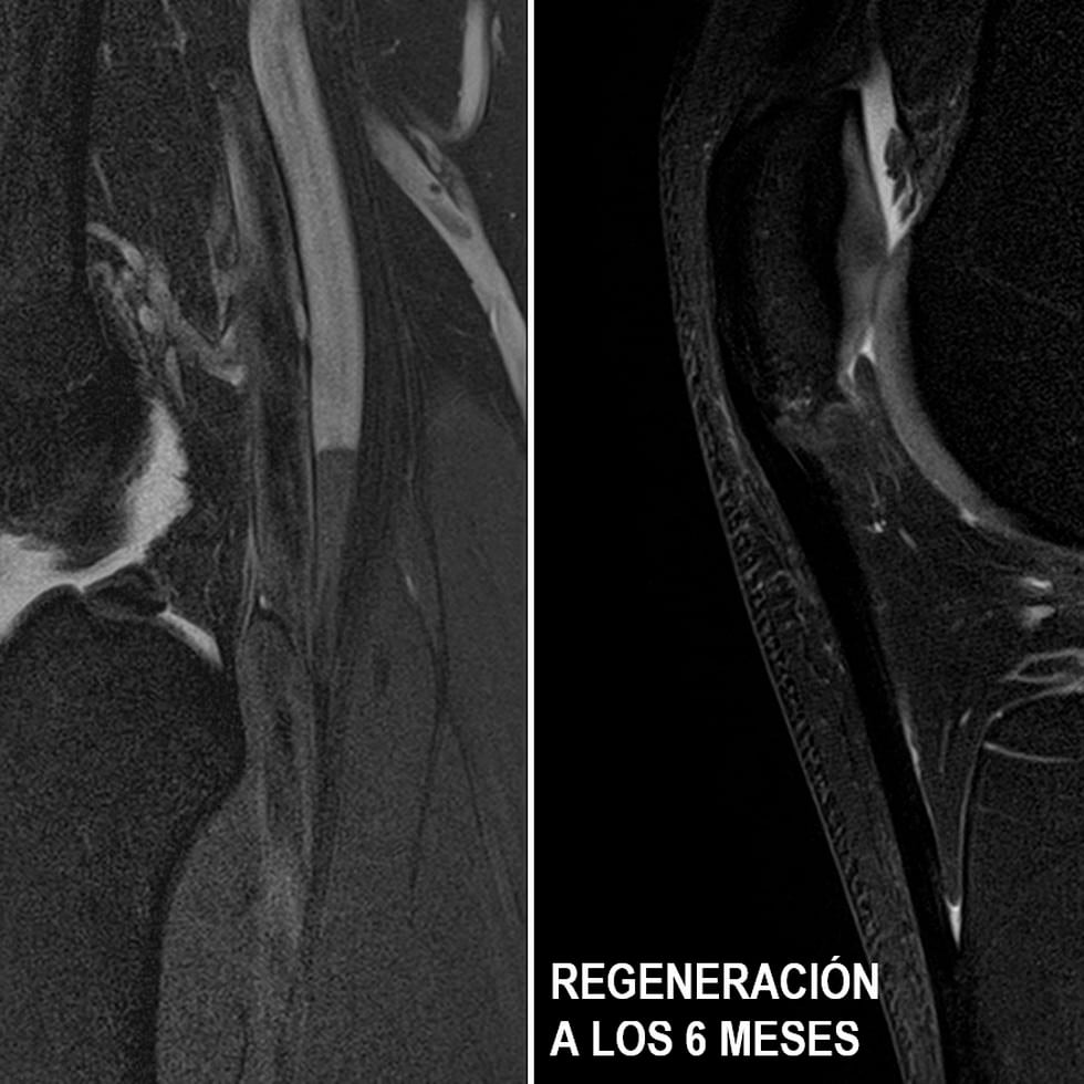 El ensayo clínico muestra un grado de regeneración sin precedentes en el 100% de los pacientes, con disminución del dolor y reincorporación a la práctica deportiva a los dos meses.