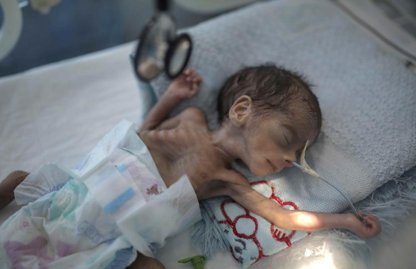 Niño yace en el hospital Al-Sabeen en Yemen. (AP)