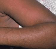 La foto muestra a un paciente que sufre de hipersensitividad inducidad por medicamentos.