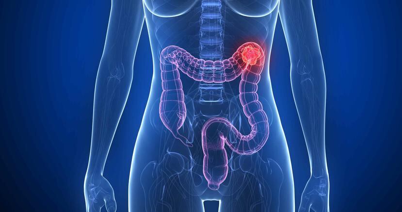Cuando se detecta en etapas tempranas, el cáncer de colon es curable en el 90 % de los casos. (Shutterstock.com)