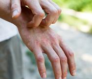 Dermatitis atópica o eczema