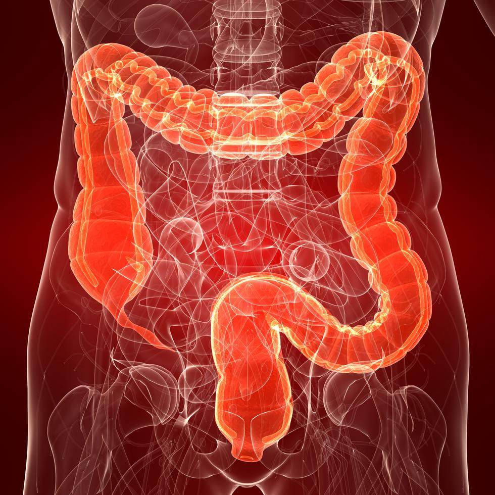 Los médicos pueden recomendar dietas especiales que pueden ayudar a tratar el síndrome de intestino irritable, mejorando su alimentación.