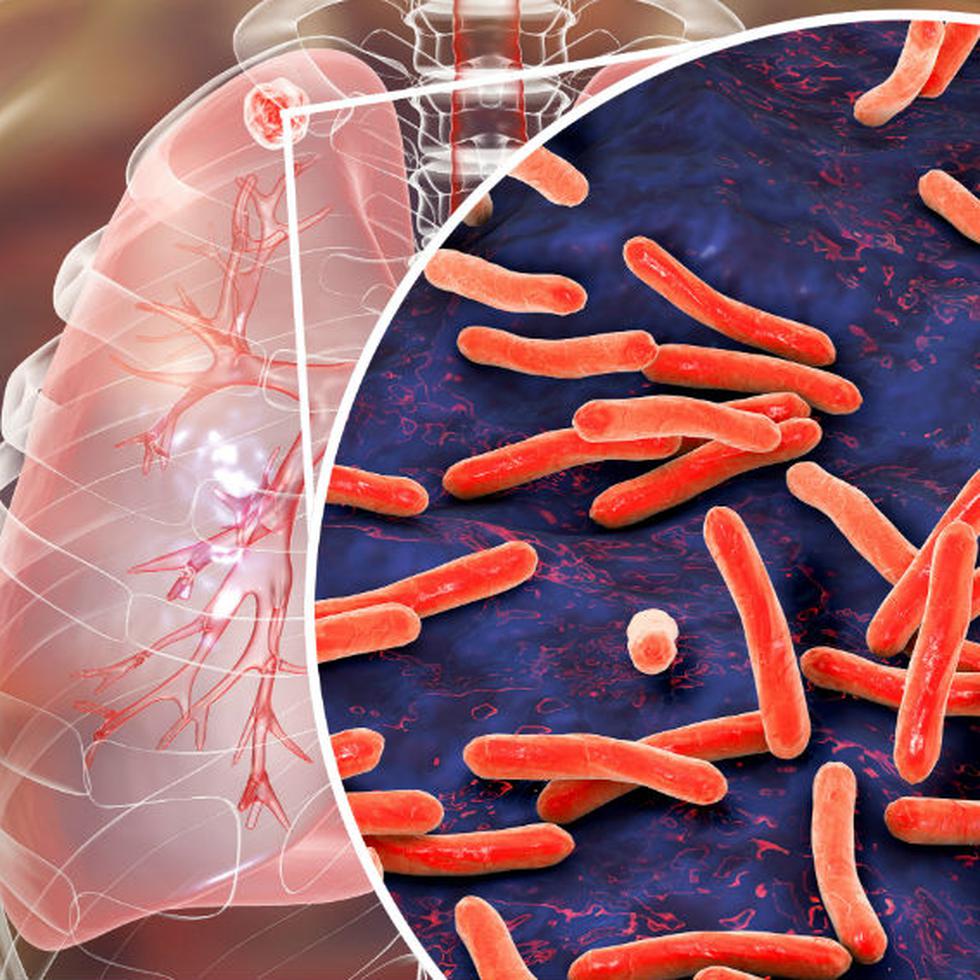 La tuberculosis activa mata cada año a unas 1.3 millones de personas en todo el mundo. (Shutterstock)