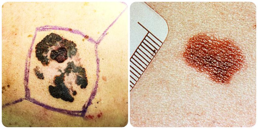Dos ejemplos de cómo puede lucir un melanoma.