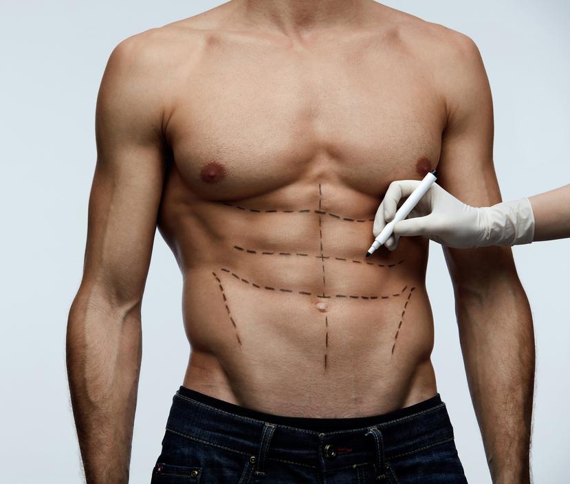 Para exhibir abdominales marcados hay procedimientos que van de lo estético a lo quirúrgico.