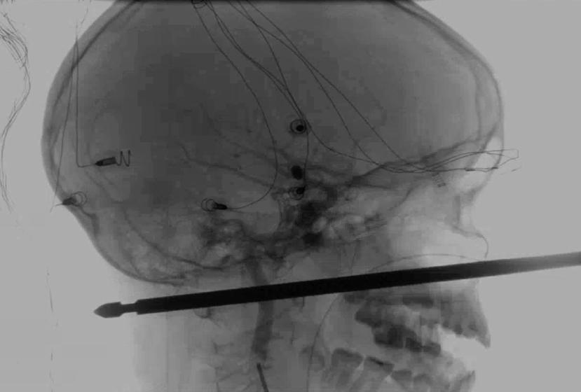 Esta foto proporcionada por Medical News Network muestra el resultado de unos rayos X en la cual se ve una brocheta atravesada en la cabeza del niño Xavier Cunningham. (AP)