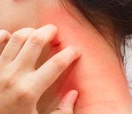 La picazón intensa es común en pacientes que padecen dermatitis atópica. (Archivo)