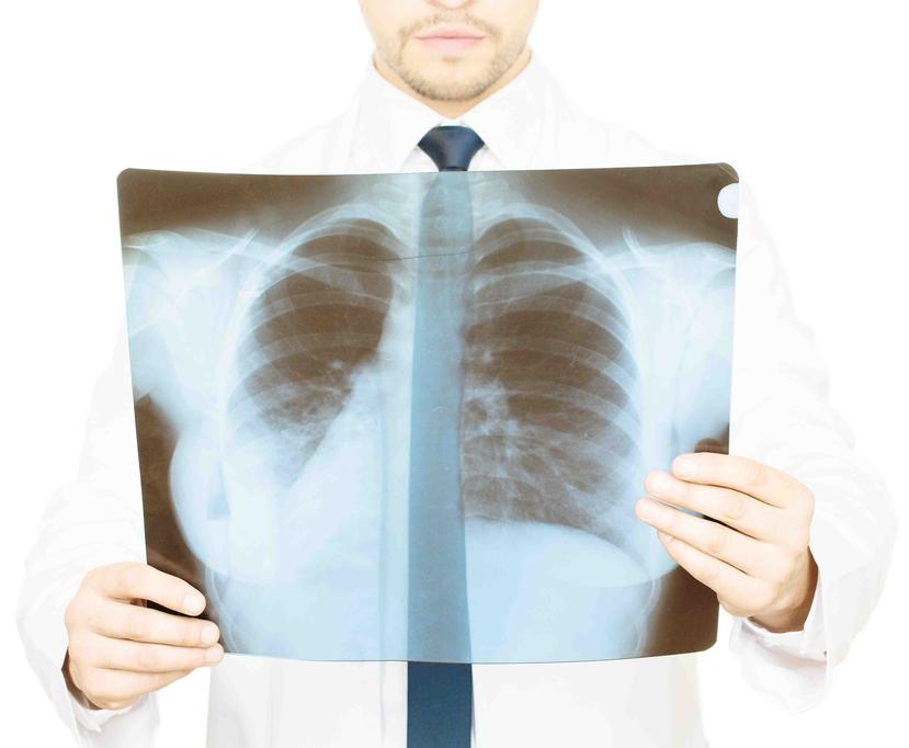 Los síntomas de la fibrosis pulmonar idiopática se pueden confundir fácilmente con los de otras enfermedades. (GFR Media)