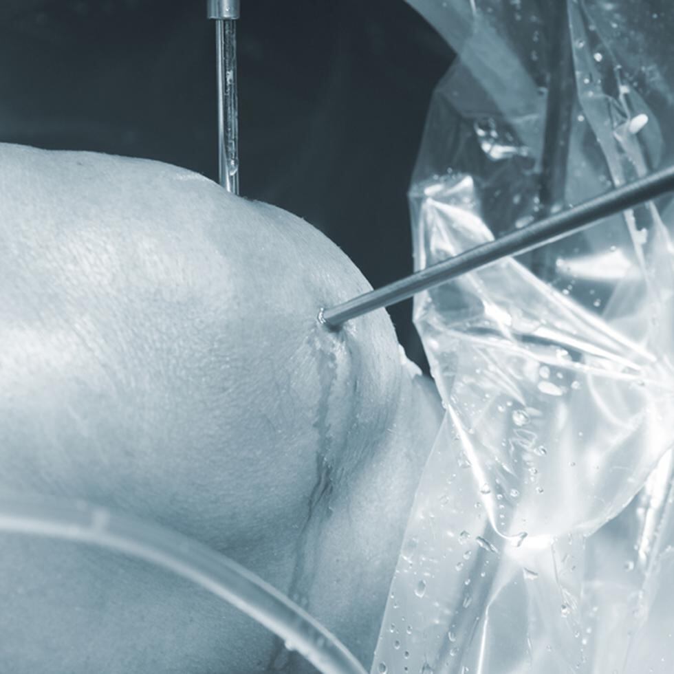 Los pacientes pueden optar por someterse a una operación para introducir una prótesis en la articulación afectada o seguir un tratamiento farmacológico. (Shutterstock)