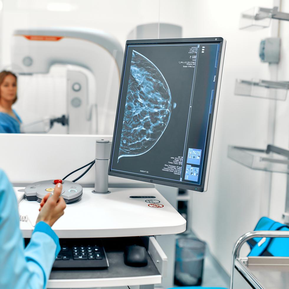 La mamografía consiste en una radiografía de los senos para detectar signos de cáncer de mama y el tejido mamario denso es uno de los factores que puede aumentar las probabilidades de que una mujer desarrolle cáncer.