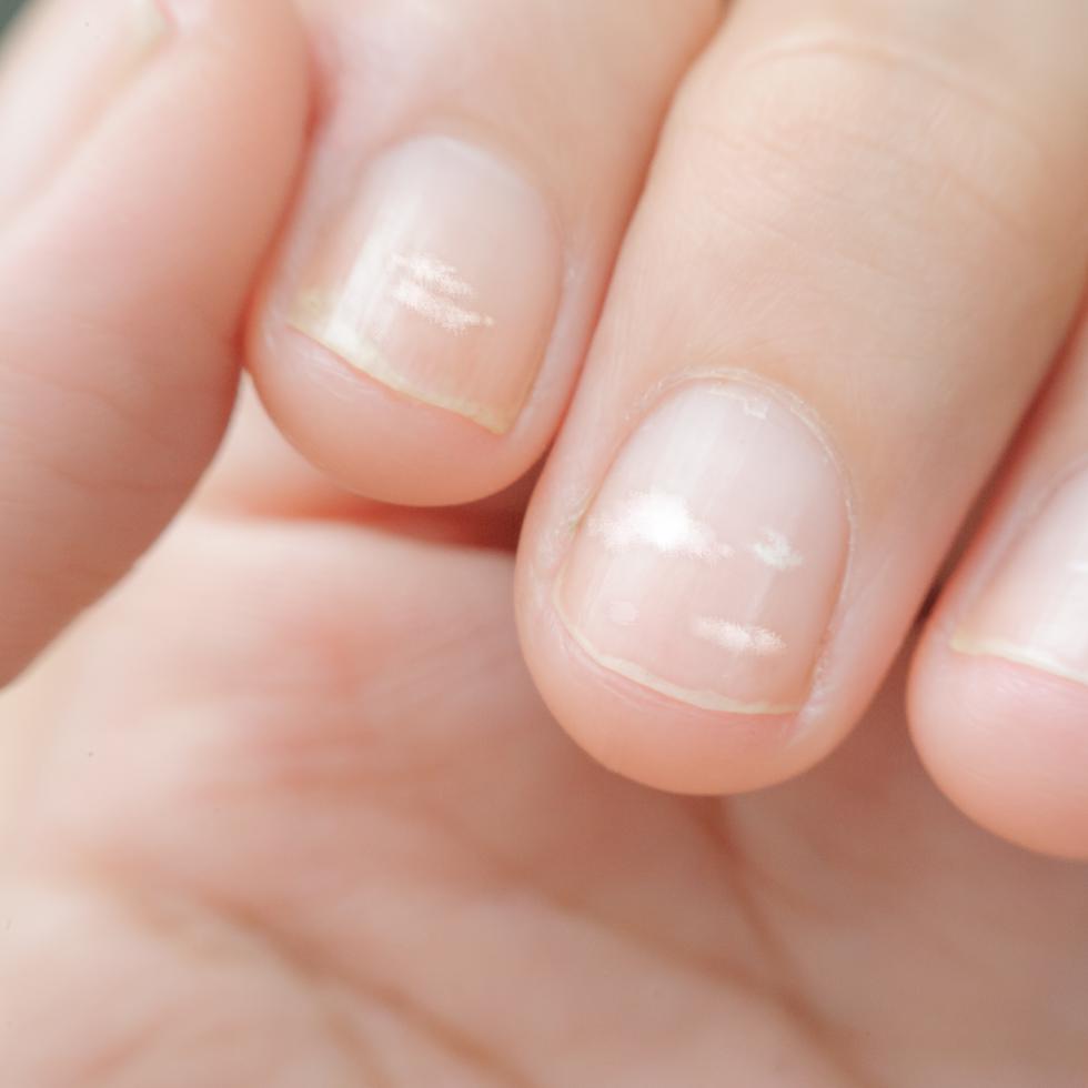 De acuerdo con su apariencia, las uñas pueden brindar información sobre distintos tipos de afecciones, dependiendo con las manchas, líneas o color que allí aparezcan.