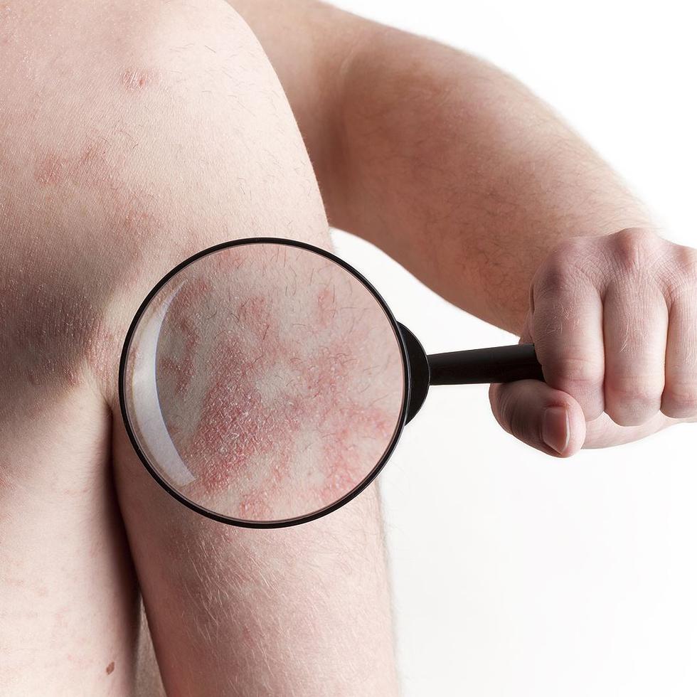 La psoriasis es una condición mediada por el sistema inmune y esto hace que se produzcan placas inflamatorias en las capas altas de la piel. (GFR Media)