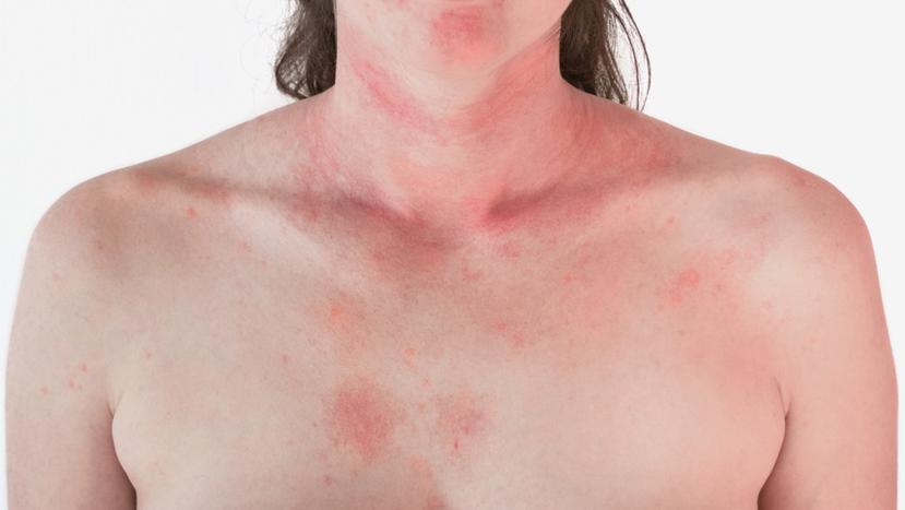 Una de las lesiones comunes en piel causada por el coronavirus, que parece urticaria es de color rosa y se unen unas con otras. (Shutterstock)