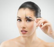 Existen muchos mitos alrededor del tema del acné.