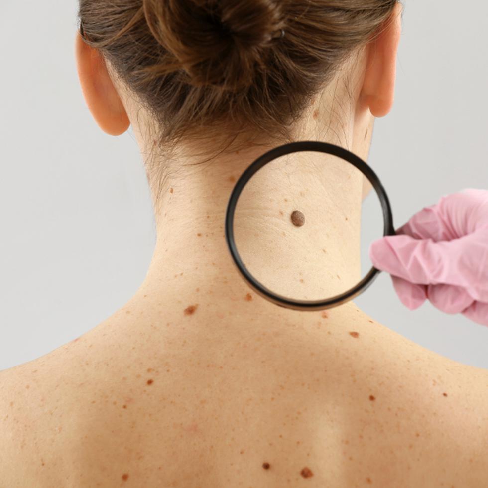 El melanoma no es el cáncer de piel más frecuente, pero si no se detecta y se trata a tiempo es el más peligroso porque se puede propagar a otras partes del organismo.