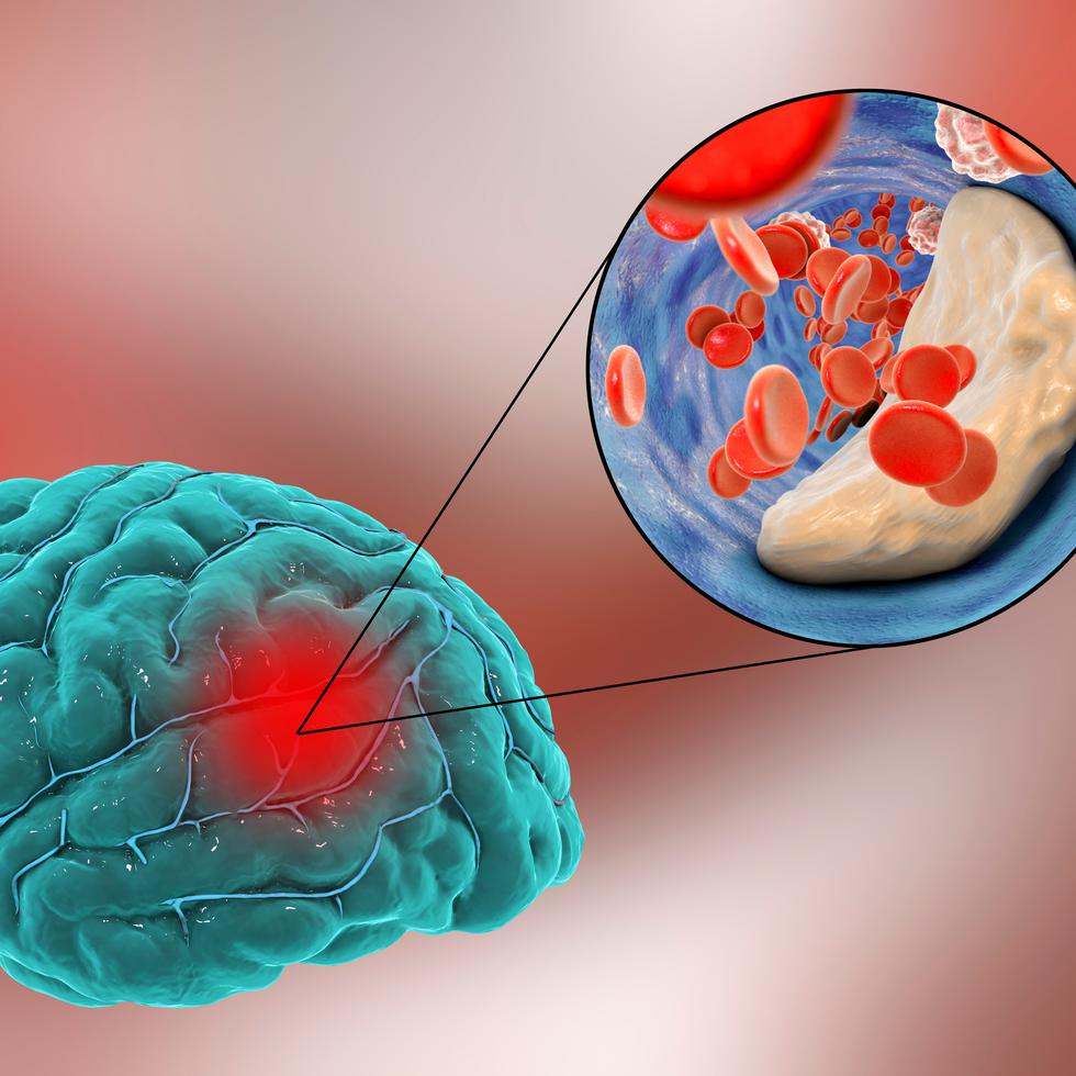 Un ictus isquémico es causado por un trombo o coágulo sanguíneo alojado en el lumen (canal interior) de una arteria cerebral.