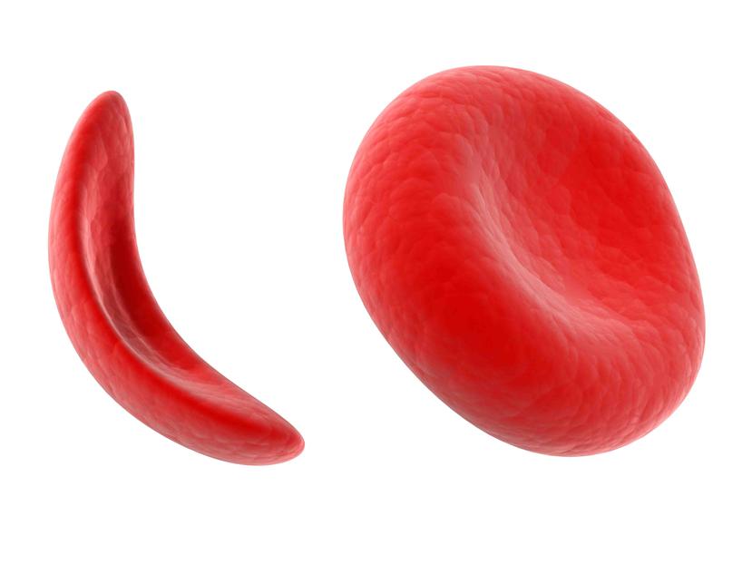 Los glóbulos deformados se llaman glóbulos rojos falciformes y solo duran de 6 a 10 días, lo cual causa una constante anemia. (Foto: Shutterstock.com)