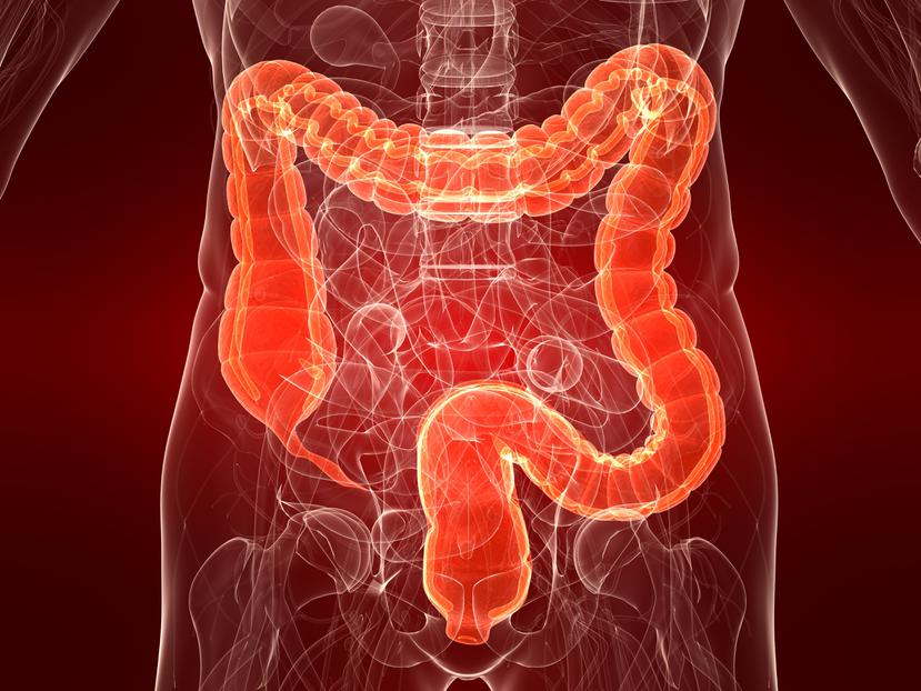 Composición fotográfica del cáncer de colon