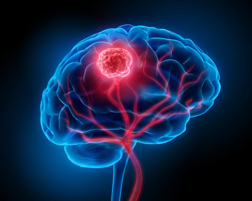 El glioma es un tipo de cáncer en cerebro muy agresivo, que afecta la función cerebral y es potencialmente mortal según su ubicación y velocidad de crecimiento.
