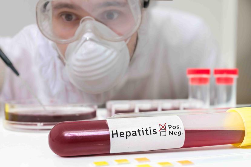 La hepatitis es la inflamación del hígado, causada en la mayoría de los casos por una infección vírica debido a cinco virus principales: A, B, C, D, E. (Archivo/ GFR Media)