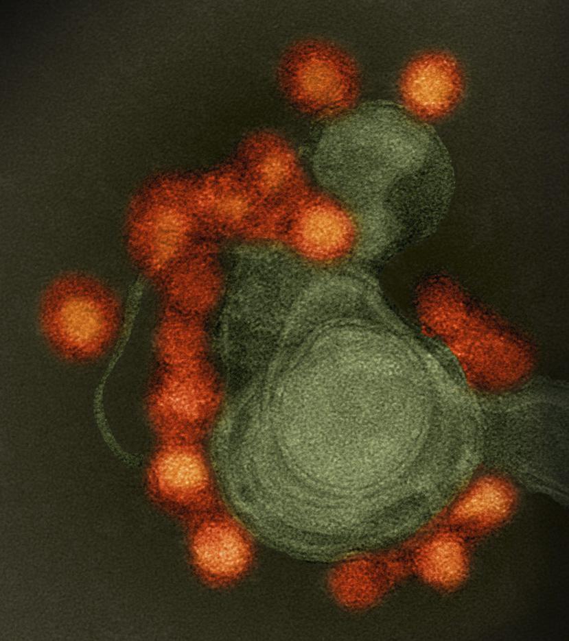 El virus zika (en rojo) ampliado con un microscopio electrónico, de un caso de microcefalia en Brasil. (EFE)