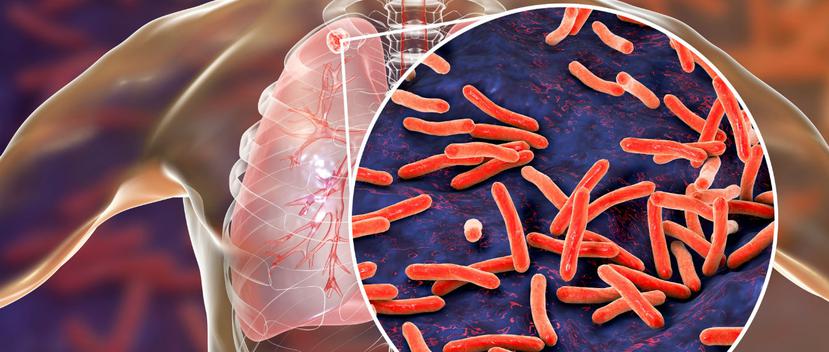 La tuberculosis activa mata cada año a unas 1.3 millones de personas en todo el mundo. (Shutterstock)