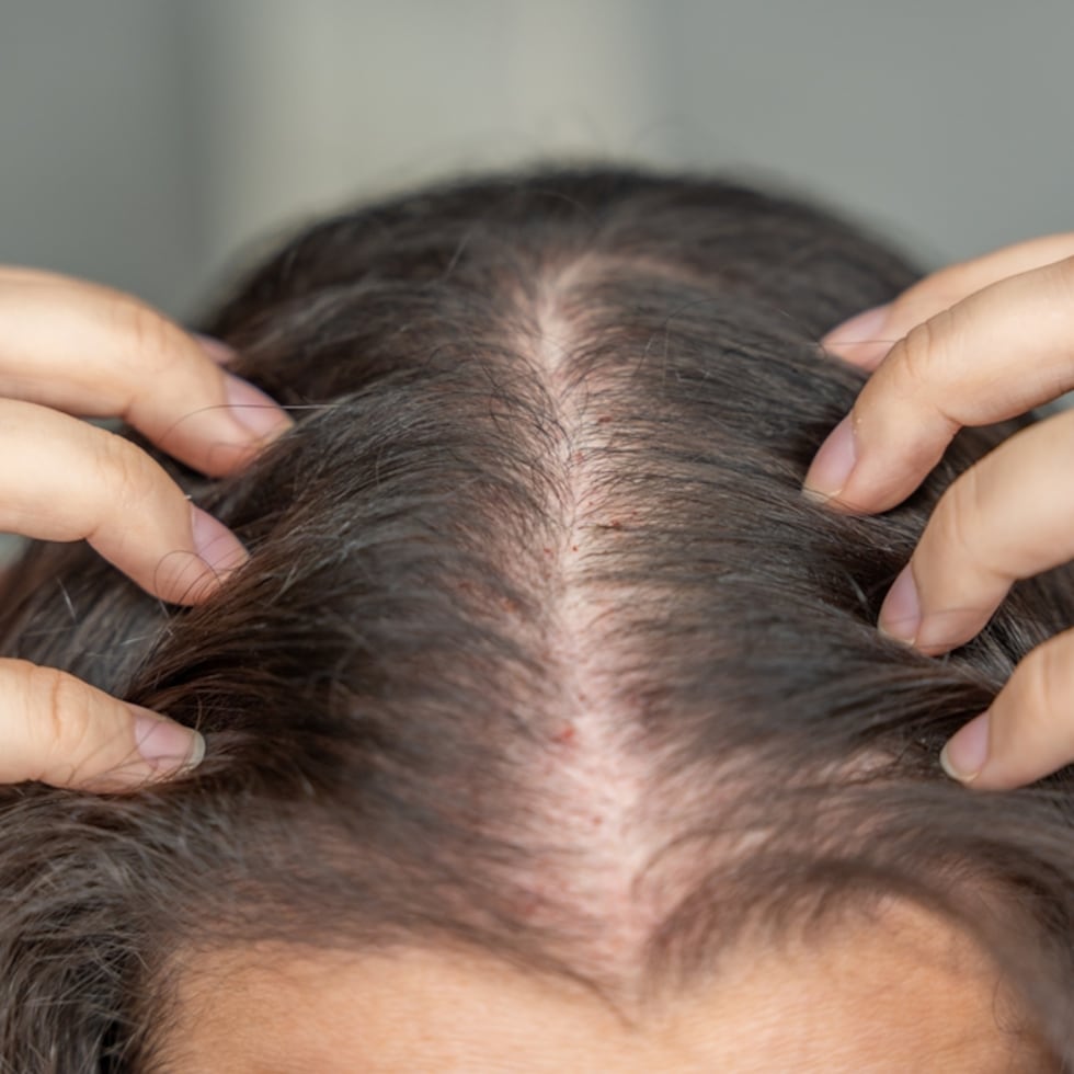 El estudio demostró un crecimiento del cabello temprano y sustancial, incluso cobertura completa del cuero cabelludo.