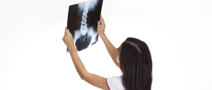 Las fracturas son, sin duda, la principal consecuencia de la osteoporosis. (Foto: Archivo/ GFR Media)