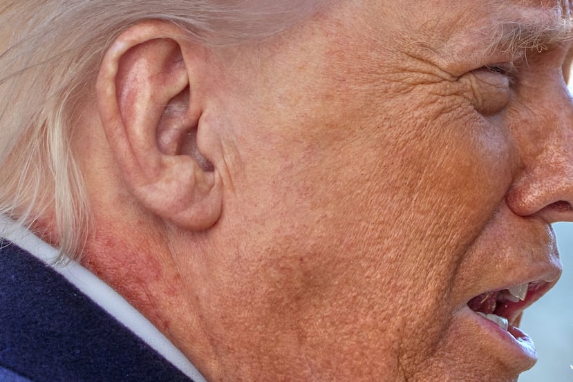 Un sarpullido rojo se observa en el cuello del presidente Donald Trump mientras hablaba con la prensa el viernes 27 de febrero de 2026, en Washington.