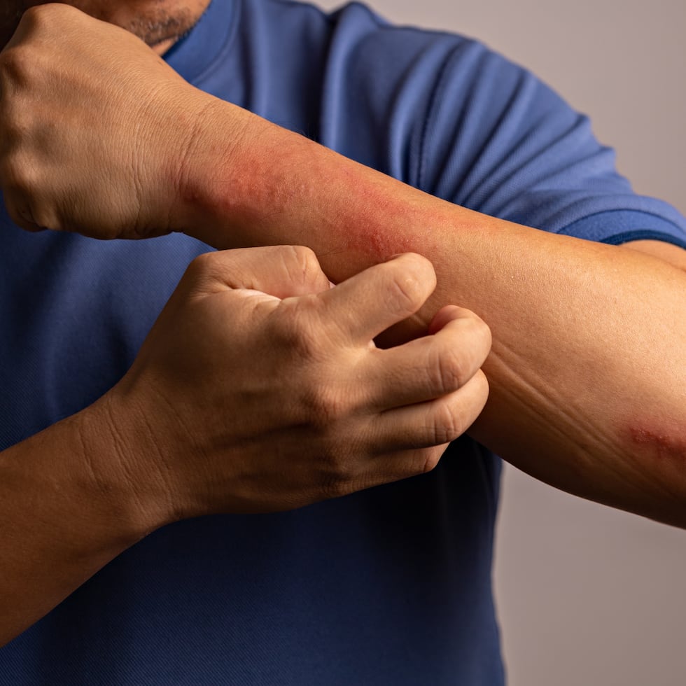 Como parte de la oferta educativa, se presentará un programa de charlas dirigidas al público sobre prevención de brotes y manejo adecuado de la dermatitis atópica.