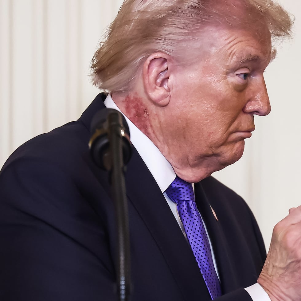 El presidente de Estados Unidos, Donald Trump, participaba el lunes por la mañana en la ceremonia de entrega de la Medalla de Honor cuando las cámaras captaron el sarpullido que asomaba por encima del cuello de su camisa.