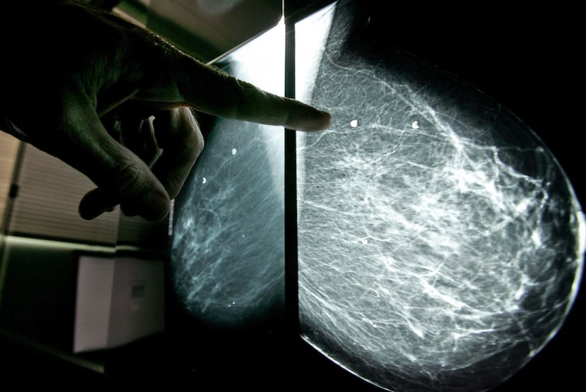 De acuerdo con las estadísticas del Registro de Cáncer de Puerto Rico, que datan del 2008, el cáncer de mama es el más común entre las mujeres. (Archivo / GFR Media)