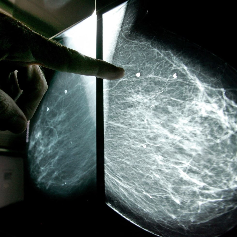 Entre 2000 y 2023, se reportaron más de 47,000 casos de cáncer de mama en Puerto Rico, siendo el tipo más común entre las mujeres, según el Registro de Cáncer.