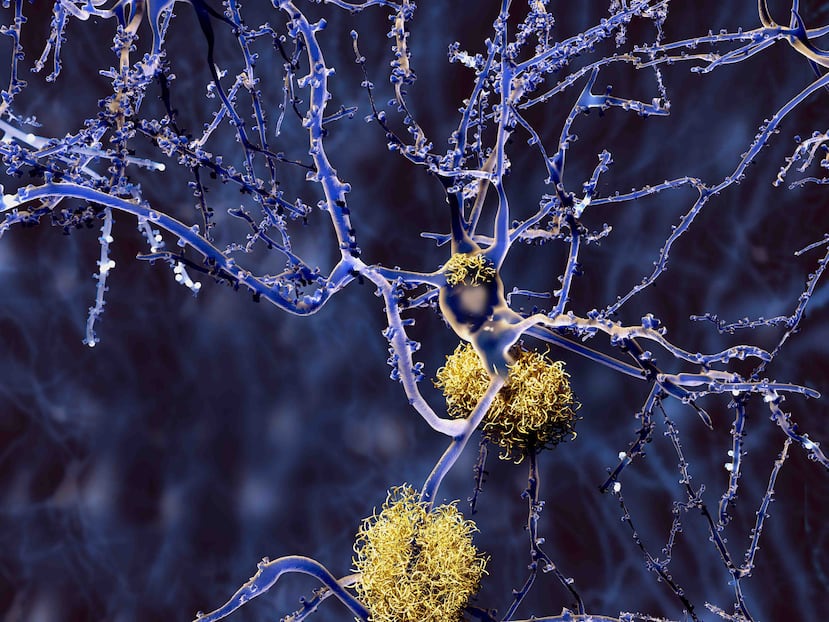 La demencia es una condición neurológica degenerativa de causa desconocida, aparentemente multifactorial que afecta principalmente la memoria y luego va deteriorando distintas funciones del cerebro. (Foto: Shutterstock.com)